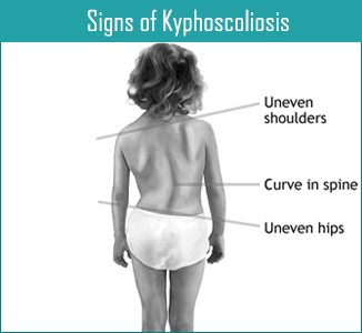 Kyphoscoliosis