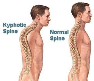 Scoliosis and Kyphosis